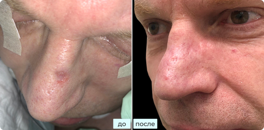 Удаление базалиомы на носу методом хирургии Моса (MOHS) с реконструкцией
