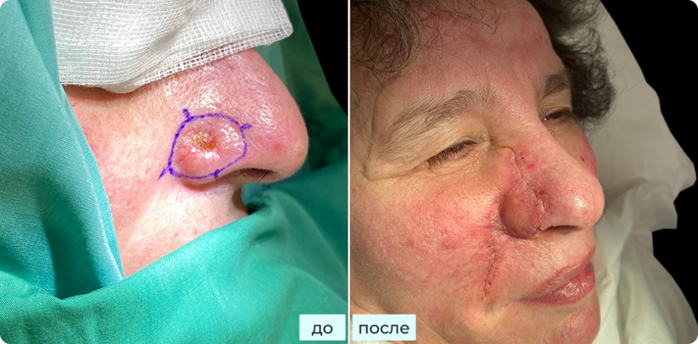 Удаление базалиомы на носу методом хирургии Моса (MOHS)  с пластикой, реконструкцией