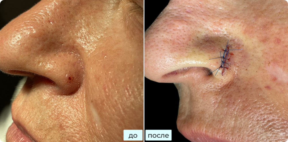 Удаление узловой базалиомы кожи носа методом хирургии Моса (MOHS)