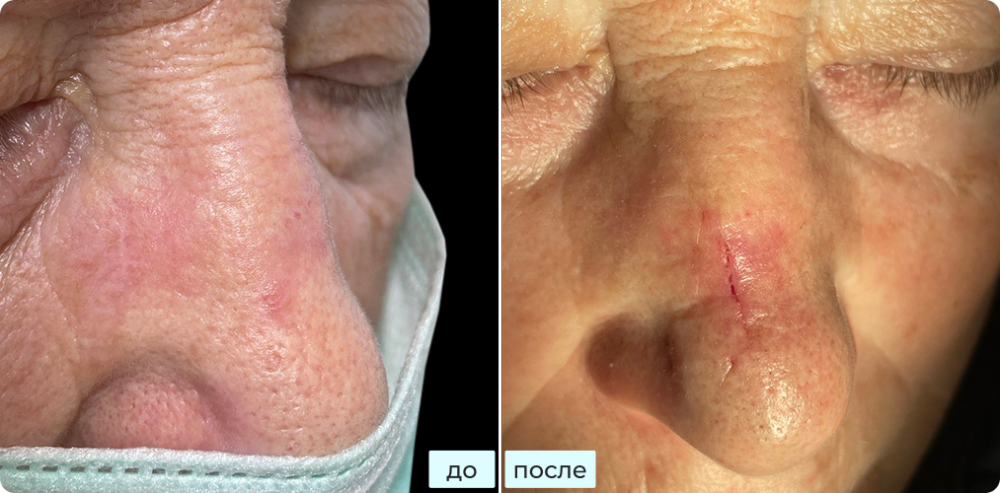 Удаление базалиомы кожи на носу методом хирургии Моса (MOHS)